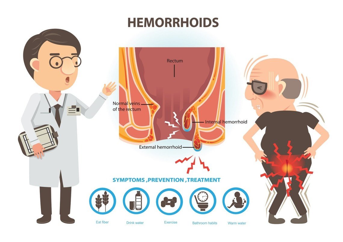 You are currently viewing Hemoroid, Pembesaran Pembuluh Darah Anus
