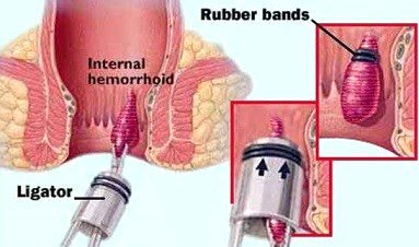 Read more about the article Rubber Band Ligation Hemoroid, Terapi Wasir Yang Banyak Diminati