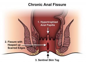 Waspadai Komplikasi Ambeien Dalam, Fisura Ani Robeknya Jaringan Kulit Anus!