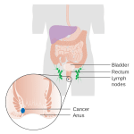 Penyebab Kanker Anus Diyakini Akibat Infeksi Menular Seksual