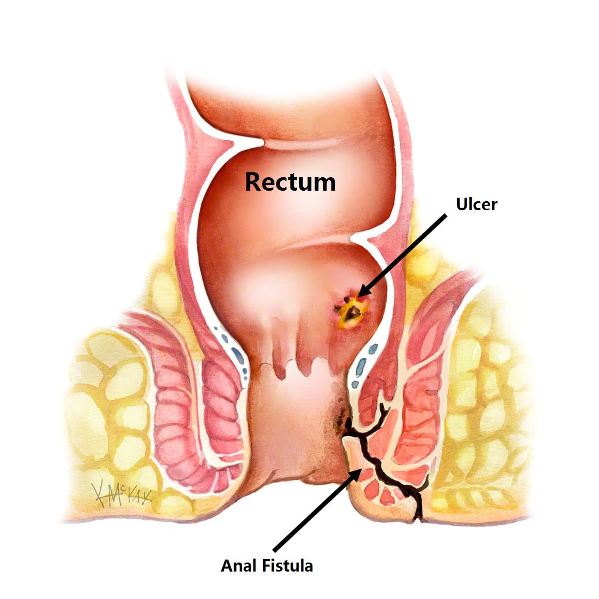 Read more about the article Fistula Perianal, Apakah Itu?