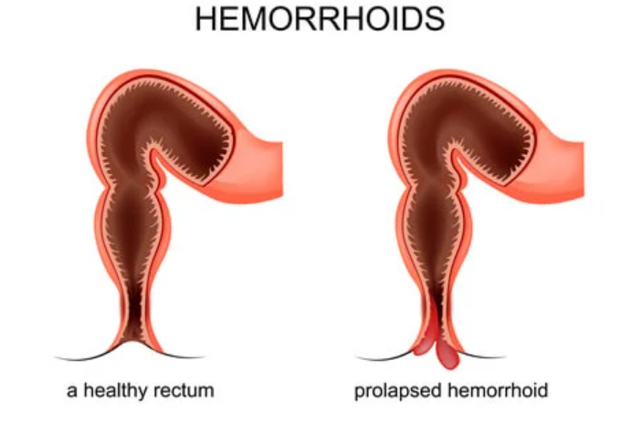 Ambeien Prolaps, Penyebab Tak Nyaman Saat Duduk