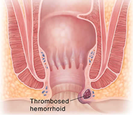 Wasir Trombosis Yang Sangat Menyakitkan